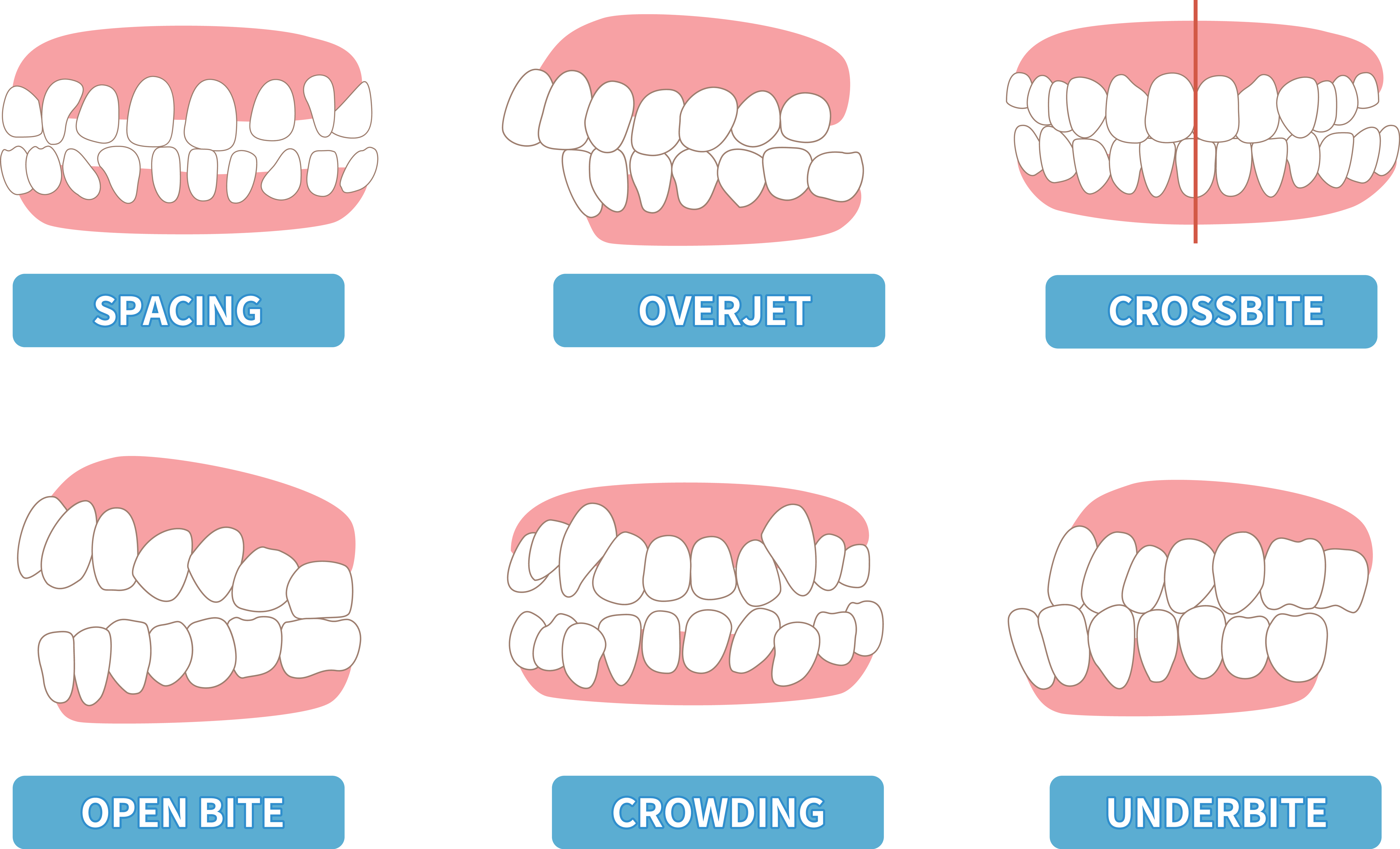 Diagrama de tipos de mordida dental
